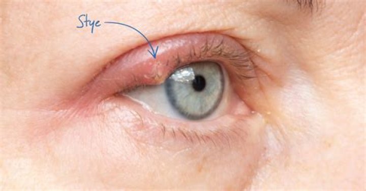 Does a potato help a stye?