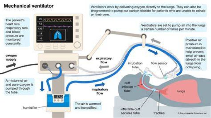Does a ventilator cause brain damage?
