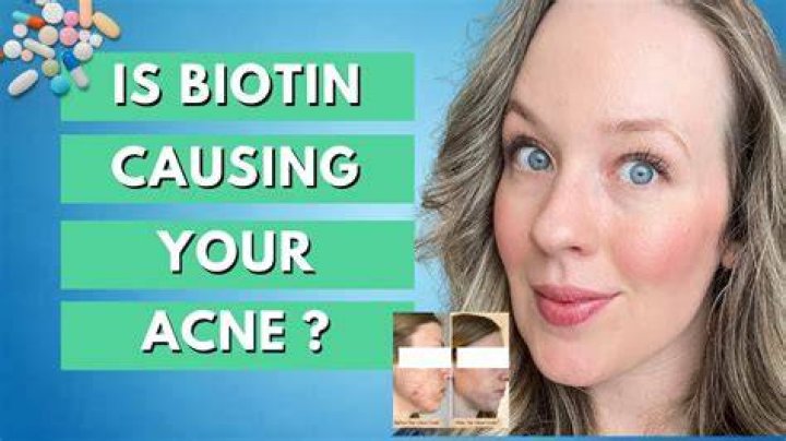 Does biotin cause pimples?