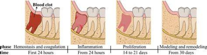 Does blood clot turn white after tooth extraction?