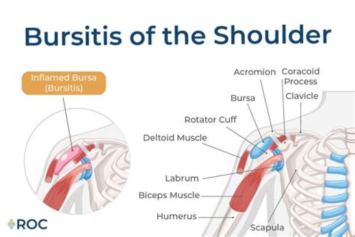 Does bursitis pain move around?