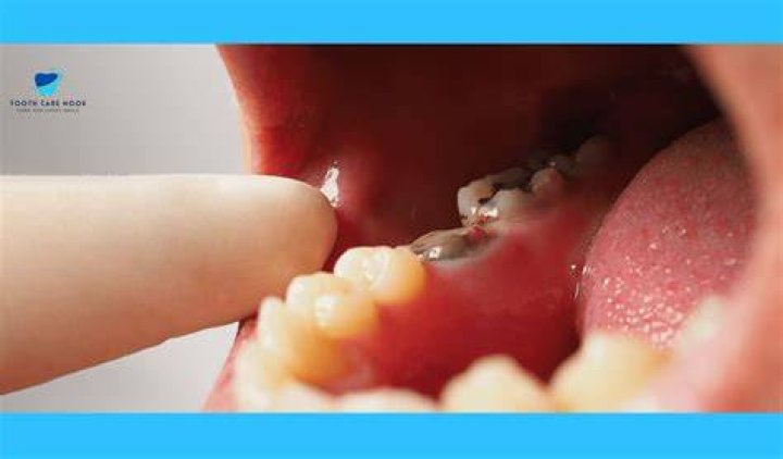 Does cavity spread to other teeth?