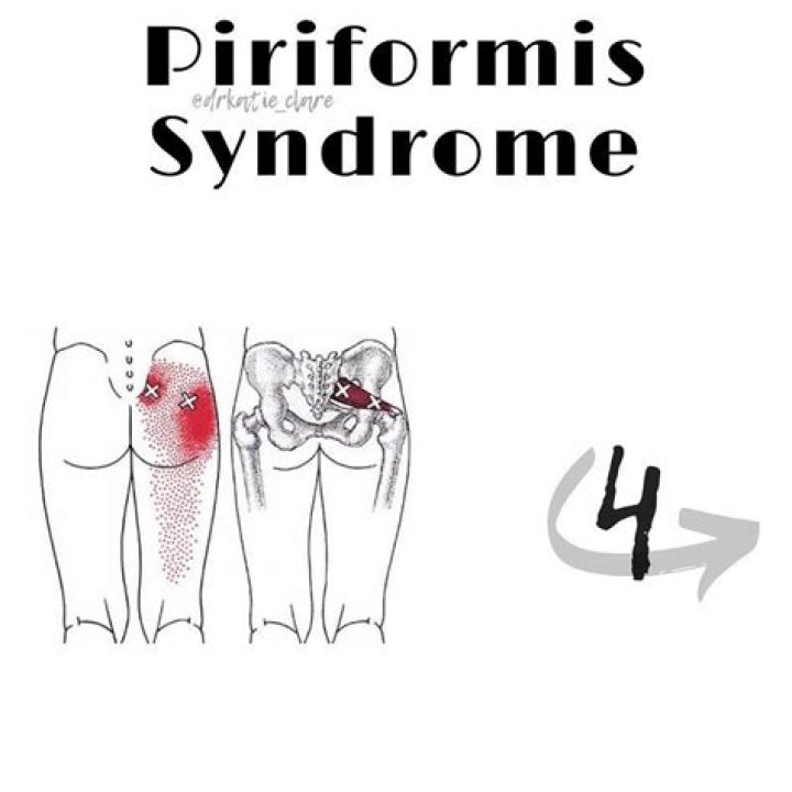 Does heat help piriformis syndrome?