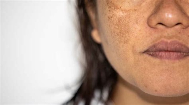 Does hyperpigmentation get darker before it fades?