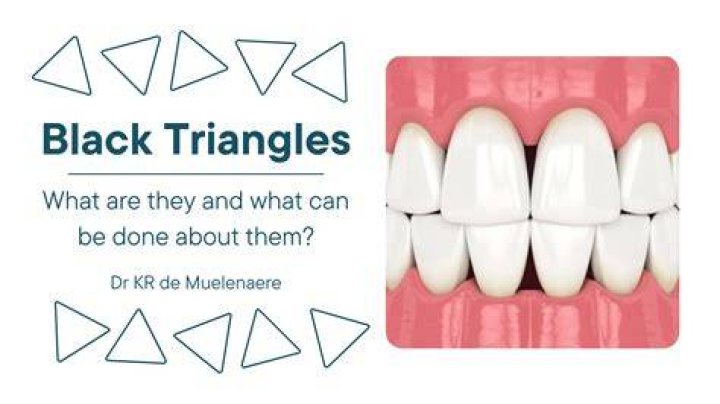 Does Invisalign cause black triangles?