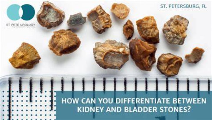 Does it hurt to pee out a kidney stone?