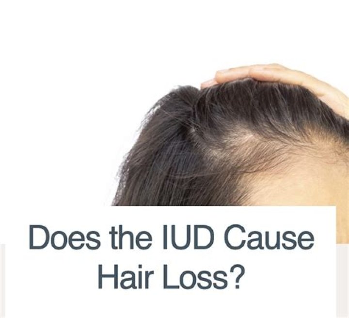 Does IUD cause hair loss?