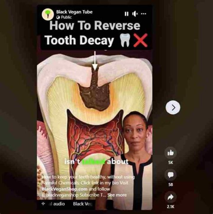 Does oil pulling reverse cavities?