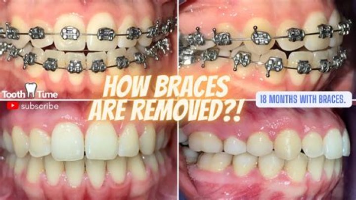 Does removing braces damage enamel?