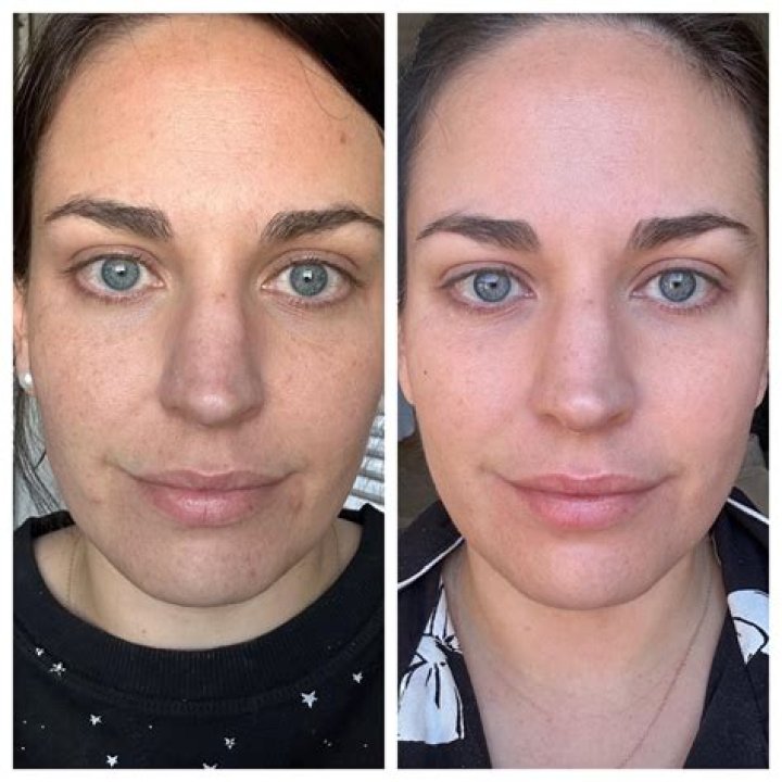 Does Retin-A shrink pores?