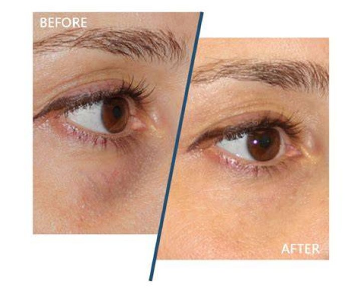 Does retinol help under eye hollows?