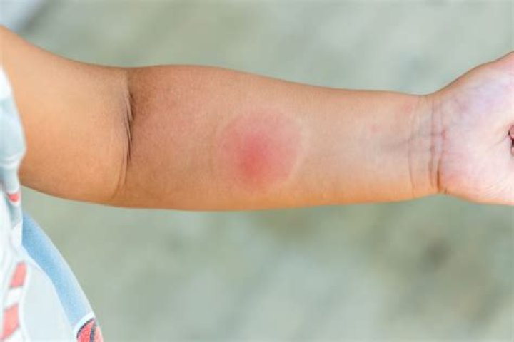 Does Vicks help mosquito bites?