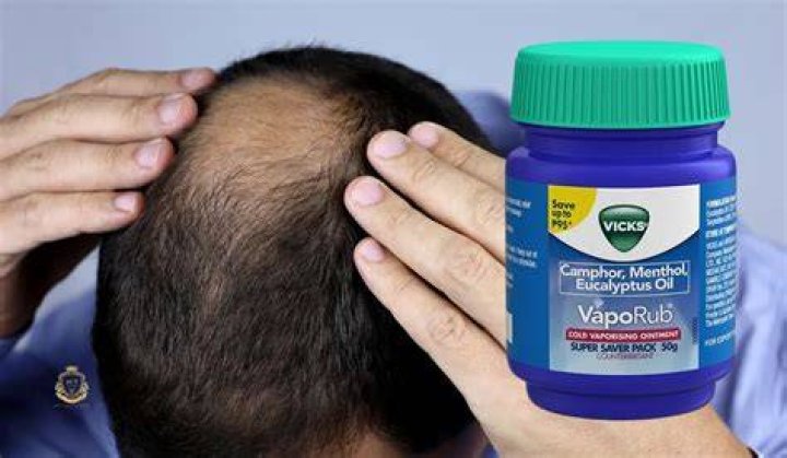 Does Vicks help with alopecia?