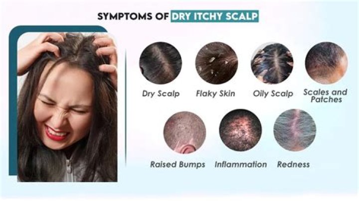 Does vinegar help itchy scalp?
