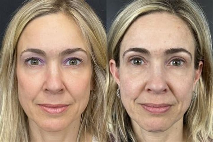 Does weight gain cause hooded eyes?