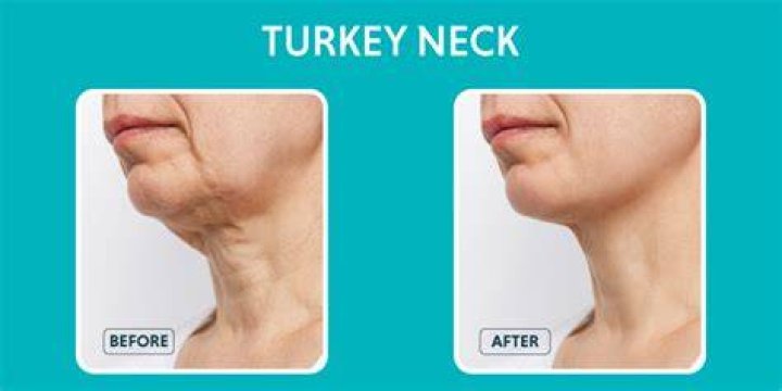 How can I stimulate collagen in my neck?