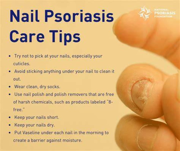 How can I treat nail psoriasis at home?