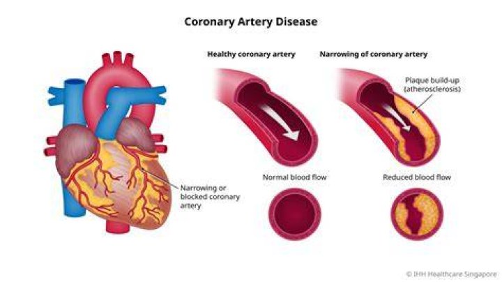 How can u tell if your arteries are clogged?