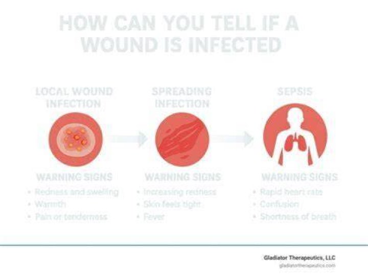 How can you tell if a wound is septic?