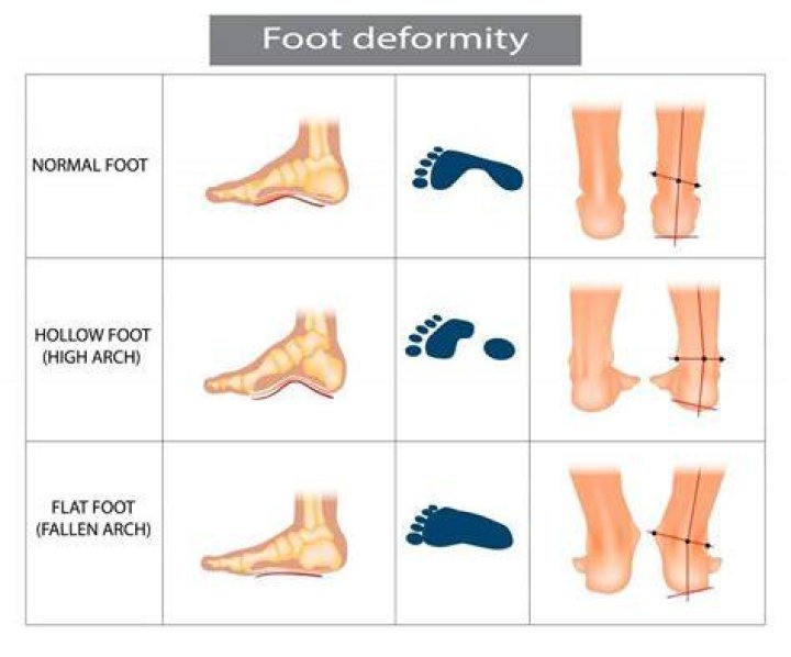 How can you tell if someone is flat footed?