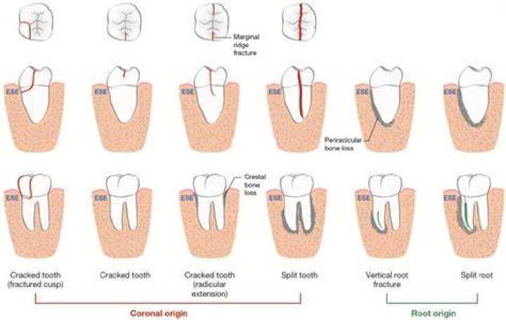 How common are shovel teeth?