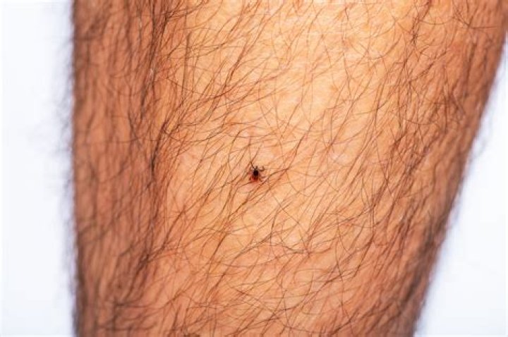 How do I know if I have a tick under my skin?