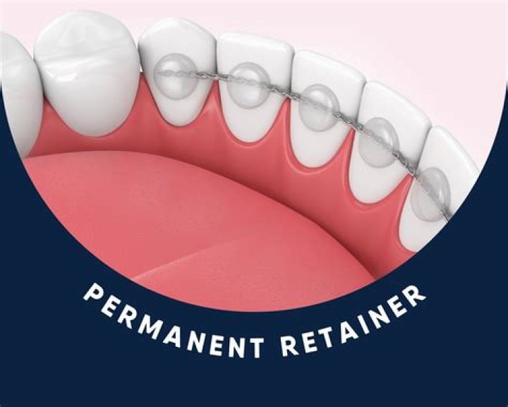 How do orthodontists remove permanent retainers?