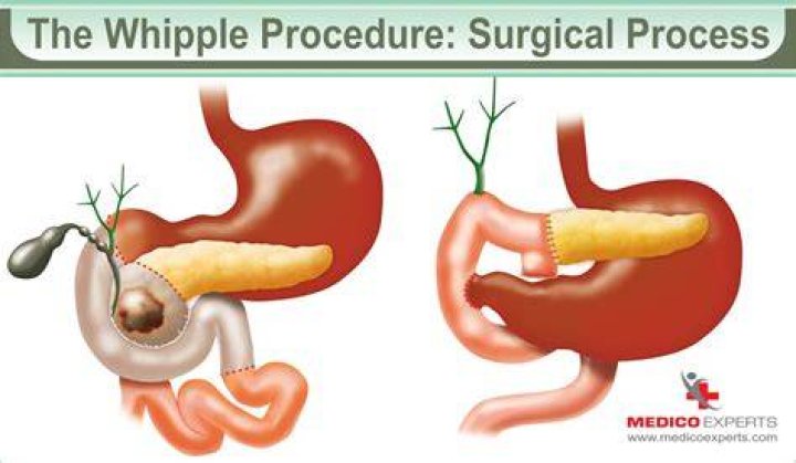 How do you catch Whipple's disease?