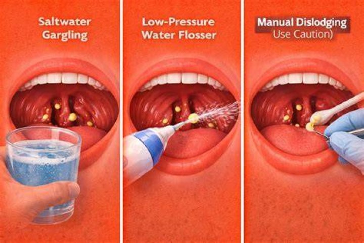 How do you get rid of labial folds?