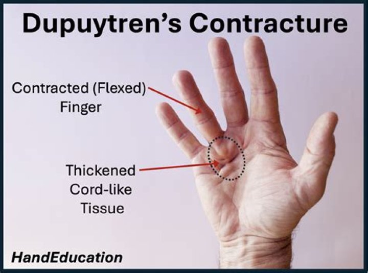 How do you slow down Dupuytren's contracture?