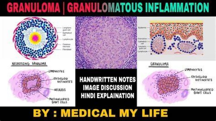 How fast do granulomas grow?