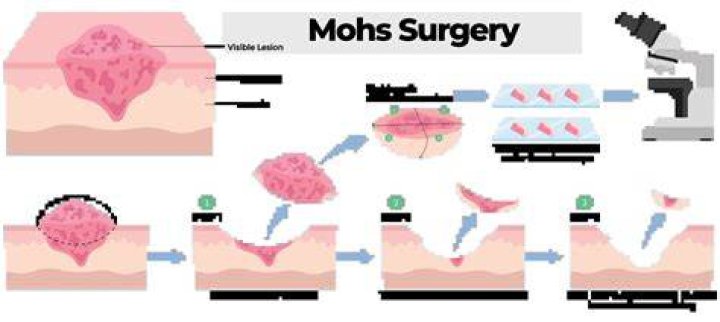 How long after Mohs surgery can I shower?