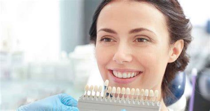 How long do dental veneers last?
