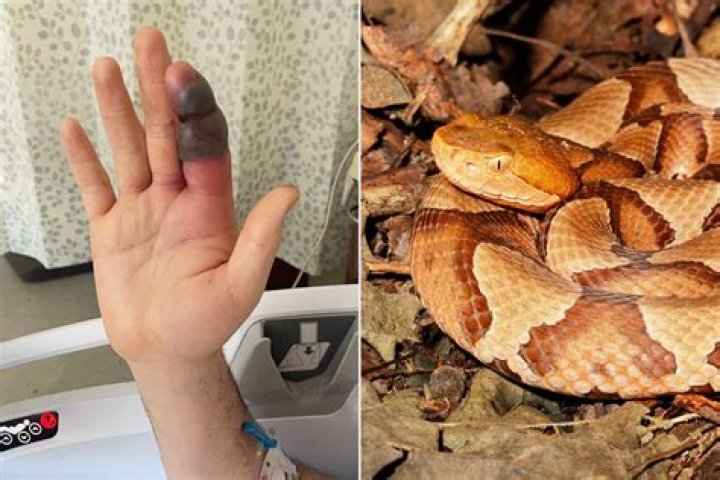 How long do you have after being bitten by a copperhead?