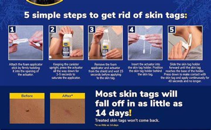 How long does a skin tag take to fall off using thread?