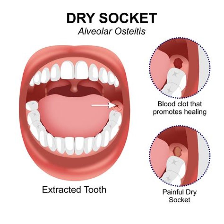 How long does dry socket last untreated?