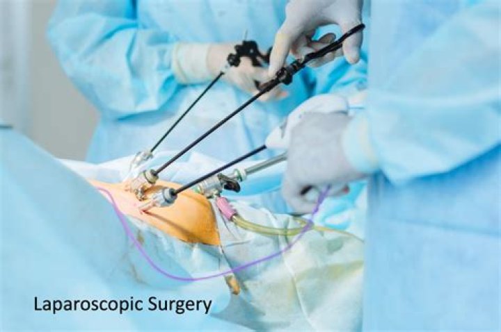 How long does gas from laparoscopic surgery last?