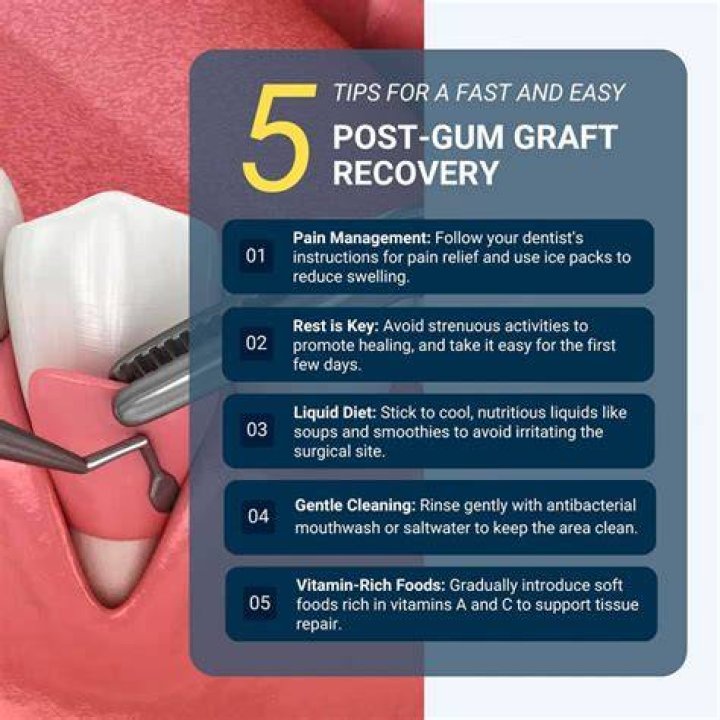 How long does it take for gum grafting to attach?