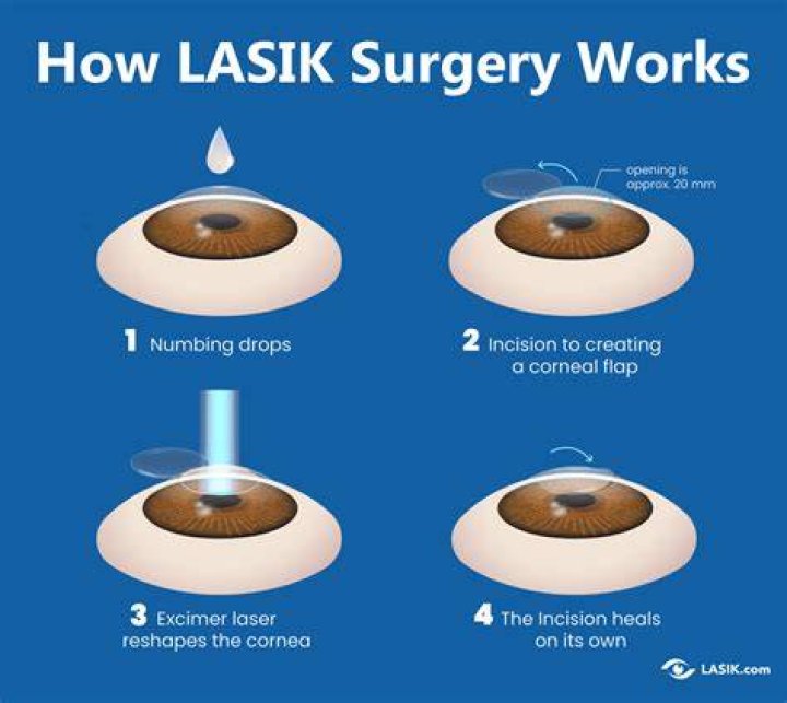 How long does it take for LASIK to stabilize?