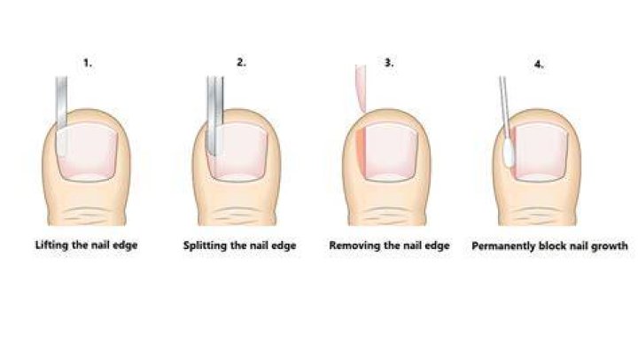 How long does it take to recover from toenail removal?