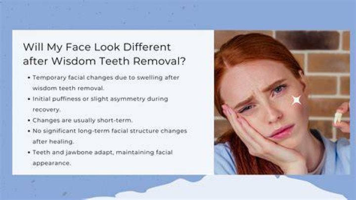How long does it usually take to get your wisdom teeth out?