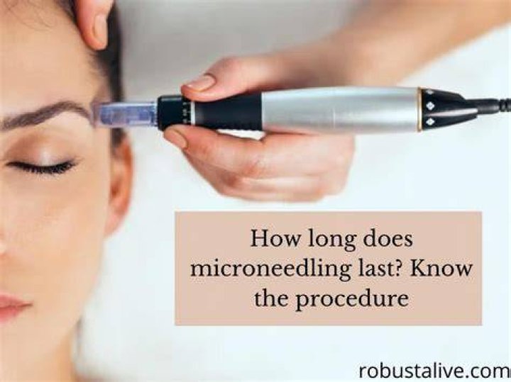 How long does microneedling last?