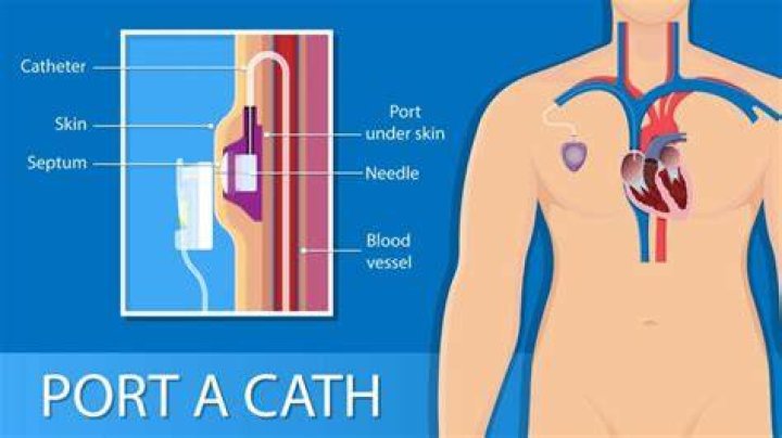 How long does port surgery hurt?