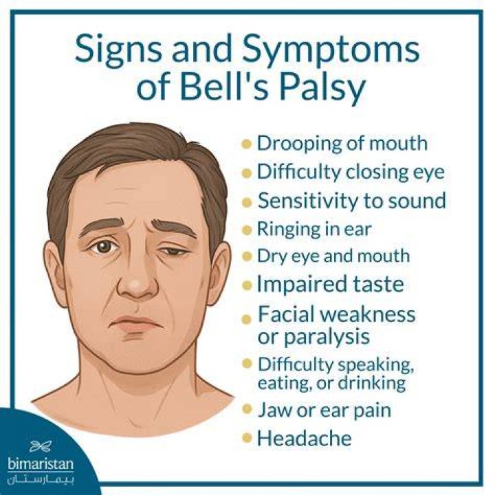 How long does the pain last with Bell's palsy?
