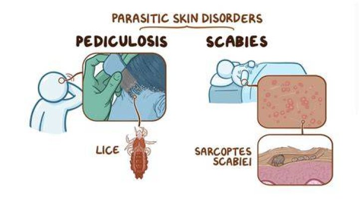 How long is a person with scabies contagious?