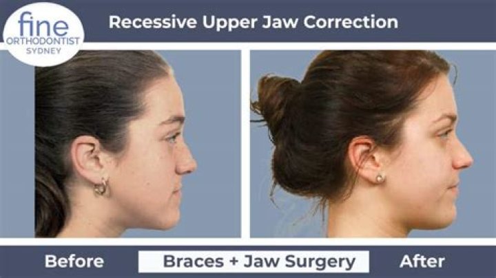 How long is your face numb after jaw surgery?
