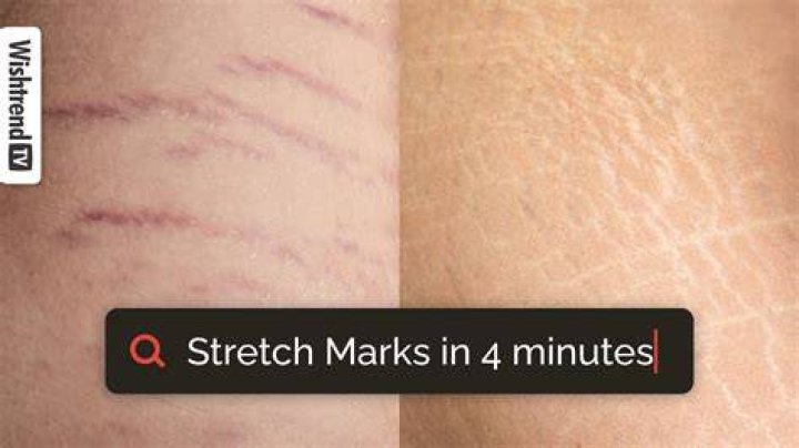 How long till stretch marks turn white?