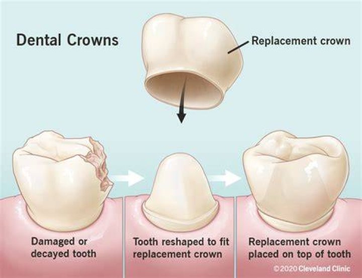 How many dental crowns can you have?