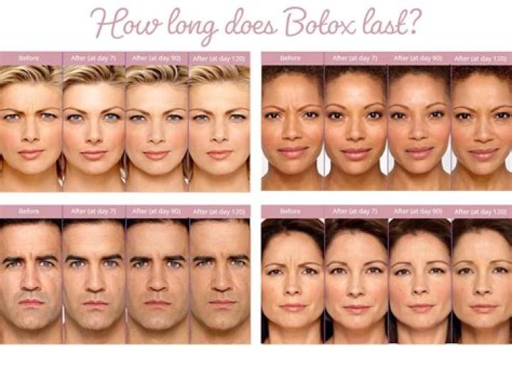 How many years can Botox Take off your face?