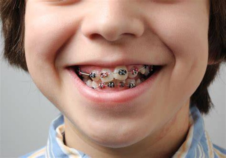 How much are braces for a 14 year old?